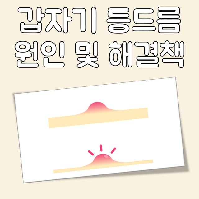 갑자기 등드름 대표 이미지