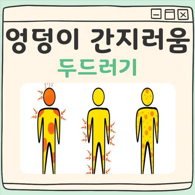 엉덩이 간지러움 두드러기 대표 이미지